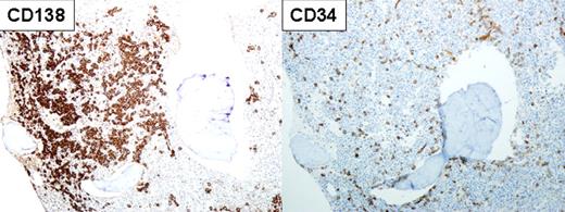 Immunostaining of the bone marrow (100× magnification) in a patient with multiple myeloma and therapy-related acute myeloid leukemia showing myeloma cells staining for CD138 (left panel) and leukemic blasts staining for CD34 (right panel) in the same specimen. See Figure 1 (top panel) in the article by Usmani et al that begins on page 1597.