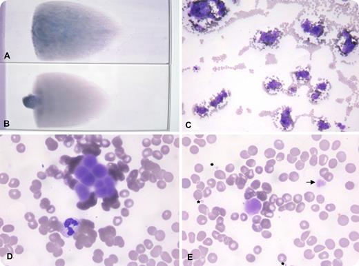 A 61-year-old male presented with 2 months of bone pain. Complete blood count showed Hb 10 g/dL, white blood cell count 4.5 × 109/L, and platelets 130 × 109/L. The peripheral smear contained visible agglutinates and a blue background color (panel A). Aggregates of amorphous particles mimicking lysed cells were observed microscopically (panels C-E) with smaller and less stained deposits (panel E arrow), some resembling platelets (panel E stars). These findings suggested cryoglobulins. After warming the blood (37°C × 4 hours), the smear regained its usual staining characteristics (panel B) and was free of microscopic deposits. A serum prepared at 37°C demonstrated protein precipitation when cooled to room temperature. This was determined to be an IgG, κ monoclonal protein (29.3 g/L). Afterward, the patient was noted to have sternal and vertebral lytic lesions. Bone marrow examination revealed 34% plasma cells, and a diagnosis of mutliple myeloma was made. / Cryoglobulins may occur in multiple myeloma and non-Hodgkin lymphoma, and, in lesser quantities, in viral illnesses, connective tissue diseases, and some renal diseases. Cryoglobulins are rarely observed macroscopically on a peripheral smear. In this case they were seen as precipitates of pale amorphous particles between red cells with smaller particles that appeared as platelets.