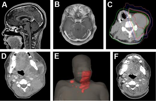 Figure 1. Extent of disease among the ATL patient cohort. CT slices in the sagittal (A) and axial (B) planes of a patient with leptomeningeal disease. (C) CT slice in the axial plane of a patient with extensive cervical neck lymphadenopathy. The patient was treated with a right anterior oblique and left posterior oblique photon beam arrangement to gross adenopathy, contoured in red, with radiation isodose lines also depicted (green indicates 102% of the prescribed dose; red, 100%; yellow, 99%; lavender, 98%; cyan, 95%; dark blue, 50%; and pink, 20%). (D) Disease extent in another patient with bilateral, left greater than right, cervical and supraclavicular lymphadenopathy depicted in the axial plan and (E) as a 3-dimensional body reconstruction image with gross tumor contoured in red. (F) Treatment response of the same patient depicted in panels D and E, shown in the axial plane at 7 weeks after photon radiation therapy to the left neck only. A strong partial response to radiation therapy was obtained in this patient.