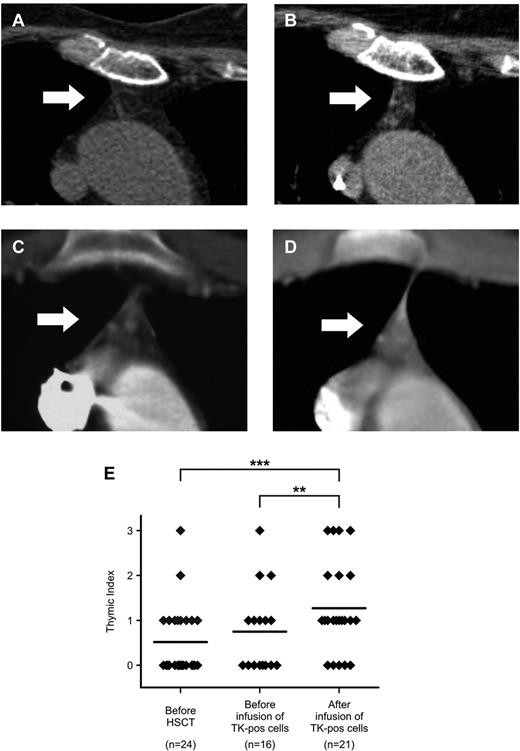 Figure 4. Chest CT scans document an increase in the volume of active thymic tissue after TK+-cell add-backs. (A-D) Detail on the thymic region (indicated by white arrows) from chest CT scans performed for diagnostic purposes in 2 representative TK007 patients (panels A-B: UPN# 25, age 64; panels C-D: UPN#15, age 17). Note the increase in density in the thymic region in the scans performed after TK+-cell add-backs (for panel B, TI = 2 and for panel D, TI = 3, performed at 50 and 135 days from last TK+-cell add-back, respectively) compared with their counterparts before treatment (panels A and C, both TI = 1). (E) Summary of results obtained from the retrospective analysis of 61 chest CT scans from TK007 patients, each scored a TI value by 2 independent expert radiologists (y-axis). **P = .0039; ***P < .0001 in a paired-sample Student t test.