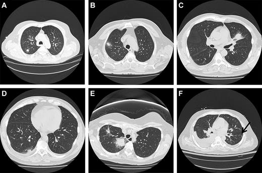 Figure 1. Radiographs of different types of nodular lesions. (A) Solitary nodule. (B) Nodule with surrounding ground-glass halo. (C) Mass-like consolidation with surrounding halo of ground-glass opacity. (D) Peripheral pleural-based nodule with pleural effusion. (E) Large central irregular speculated density with surrounding ground-glass opacity and smaller more peripheral speculated lesion. (F) Cavitary nodule with sequestrum (air-crescent sign).