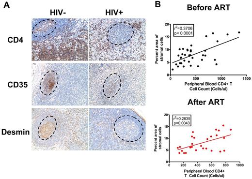 Figure 6. Depletion of CD4 T cells correlates with depletion of FRC and FDC networks in HIV-1 infection. (A) Immunohistochemical staining of CD4, CD35, and desmin in LNs from uninfected and chronically HIV-1–infected subjects, showing the depletion of CD4 T cells in B-cell follicles and T-cell zone correlates with depletion of FDCs and FRCs in B-cell follicles and T-cell zone. Dotted circles represent the position of B-cell follicles. Original magnification ×200. (B) Correlation between the percent area of stromal cells and peripheral blood CD4 T-cell counts (cells/μL) before (top panel) and after (bottom panel) the initiation of ART.