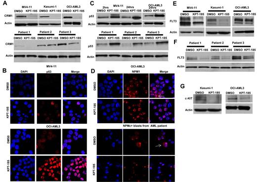 Figure 2. KPT-SINE treatment causes decrease of CRM1 protein level, accumulation of CRM1 cargo proteins in the nucleus, and down-regulation of FLT3 and KIT oncoproteins. (A) Top panel: CRM1 protein expression as measured by Western blotting in MV4-11, Kasumi-1, and OCI-AML3 cells after KPT-185 treatment or control (DMSO) after 24 hours. Loading control is actin. Bottom panel: CRM1 protein expression as measured by Western blotting in 3 primary AML blasts after KPT-185 treatment or control. (B) Confocal microscopy of p53 in MV4-11 and OCI-AML3 cells treated with KPT-185 or control at 24 hours. Left panel: DAPI staining (cell nucleus). Middle panel: p53 staining. Right panel: merge of p53 and DAPI staining. Note the increase in the p53 expression in the nucleolus. (C) Whole-cell p53 protein expression in MV4-11 and OCI-AML3 cells (top panel) or primary AML blasts (n = 3) after KPT-185 or control treatment at 2 and 24 hours. (D) Confocal microscopy of NPM1 in OCI-AML3 cells and in a primary AML blast from a patient with CN-AML and NPM1 mutation treated with KPT-185 or control at 24 hours. Left panel: DAPI staining (cell nucleus). Middle panel: NPM1 staining. Right panel: merge of NPM1 and DAPI staining. The arrows indicate the localization of NPM1 in the cytoplasm (NPMc+) in the untreated samples and the elimination of the cytoplasmic signal on treatment with the drug, being detected exclusively in the nucleus. (E) FLT3 protein expression in MV4-11, Kasumi-1, and OCI-AML3 cells as measured by Western blotting after KPT-185 treatment or control at 24 hours. (F) FLT3 protein expression in primary AML blasts as measured by Western blotting after KPT-185 treatment or control at 24 hours: patient 1, CN-AML NPM1 WT, FLT3 ITD+; patient 2, CN-AML, NPM1 mutated, FLT3 WT; and patient 3, CN-AML, NPM1 mutated, FLT3 WT. (G) c-KIT expression in Kasumi-1 and OCI-AML3 cells after KPT-185 treatment or control at 24 hours.
