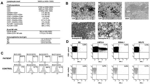 Figure 1. Immunological features of the patient. (A) Lymphocytes subpopulations. Serum immunoglobulin levels. (B) Liver histopathology. Immunohistochemistry was performed on fixed tissues with a peroxidase-based method (Dako). Antibodies used were raised against CD20, CD3, CD8, CD4 and granzyme B (Dako). EBV-encoded RNA (EBER) was probed on some specimen with the use of in situ hybridization technique. Slides were observed using a Leica DM LB microscope with ×20, ×40, and ×100 objectives and a 10× eyepiece. Aquisition of images was with IM50 software (Leica Microsystems). First line: CD8+ lymphocytic infiltrates in lobular (left) and portal (middle) area. Negative EBER staining (right). Second line: positive granzyme B staining in lobular and portal area (left and right panels, respectively). These infiltration could result of the trapping of the activated CD8+ T cells in liver during the immune response.10 (C) Immunoscope quantitative T-cell repertoire analysis. Most significant specific T-cell clonal expansion is shown. The x-axis indicates CDR3 length (in amino acid), and the y-axis displays the fluorescence intensity of the run-off products (in arbitrary units). Percentages indicate the frequency of occurrence for each Vβ family. (D) CD8+ maternal engrafted T cells express IFN-γ in response to EBV latent antigen LMP-2A antigen. Freshly isolated mononuclear cells of the patient and his mother were incubated without stimulation (NS) or in the presence of latent antigen LMP-2A, latent antigen EBNA-1, and lytic antigen BZLF-2, then stained for the expression of IFN-γ, CD3 and CD8. Numbers are the percentage of cells in the lymphoid gate expressing the indicated surface markers.
