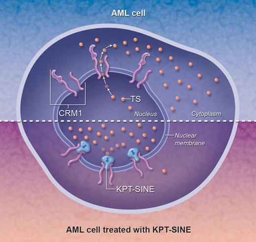 The mechanism of action of KPT-SINE. The top half represents a typical AML cell, in which tumor suppressor (TS) proteins (small orange circles) escape through the nuclear membrane via the CRM1 nuclear exporter, resulting in a distribution of TS proteins throughout the cell. Arrows indicate the outward direction of flow of the TS proteins from the nucleus into the cytoplasm. In the bottom half, KPT-SINE irreversibly locks the transporter into a conformation that blocks the normal efflux of TS proteins from the nucleus, facilitating their accumulation within the nucleus and potentially allowing TS function. Professional illustration by Alice Y. Chen.