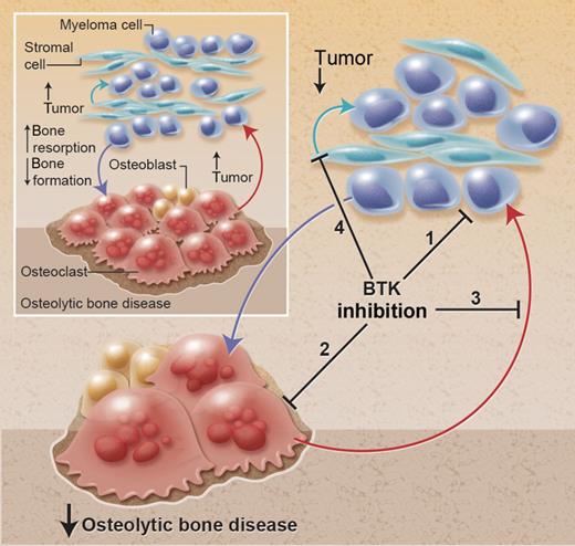 Effect of BTK inhibition in the bone microenvironment in multiple myeloma. Myeloma cells promote the development of the associated bone disease, and the bone disease promotes tumor growth and survival, resulting in a vicious cycle of increased tumor burden and increased osteolytic bone disease. BTK inhibition has multiple effects to (1) directly inhibit tumor growth, (2) directly inhibit osteoclastic bone resorption, (3) inhibit the release of osteoclast-derived tumor growth factors, and (4) prevent adhesion to bone marrow stromal cells (BMSCs) and release of BMSC-derived growth factors. The culmination of these effects is to reduce tumor burden and osteolytic bone disease. Professional illustration by Alice Y. Chen.