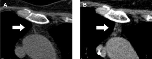 Computed tomography–based increase of the thymic density in a 64-year-old patient before (A) and after (B) add-backs of TKpos T cells. For detailed description see Figure 4 in the article by Vago et al that begins on page 1820.1