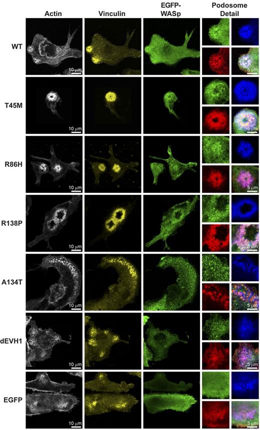 Figure 4. WASpEMM reconstitutes and localizes to structurally characteristic podosomes. WASBMDCs were plated onto fibronectin-coated glass coverslips on day 7 of culture. After 4 hours of adherence, cells were fixed and immunostained for EGFP (rabbit anti-EGFP and anti–rabbit Alexa Fluor 488), f-actin (Alexa Fluor 568 phalloidin), and vinculin (mouse anti-vinculin and goat anti–mouse Cy5). Images were taken using a Zeiss LSM710 laser scanning spectral confocal microscope and a 63× Plan-Apochromat NA 1.4 WD 190-mm oil immersion lens and processed using ImageJ Version 1.45d software. Images represent single Z stack slice through the adhesive surface of the cell, and adjustments were made to brightness, contrast, and γ only. For whole-cell images, actin is shown in white, vinculin in yellow, and EGFP-WASp in green. To aid the visualization of colocalization, in the podosomes detail panels, the colors are changed to actin in red, vinculin in blue, and EGFP-WASp in green. The bottom right panel for each construct represents a merged image of all 3 channels.
