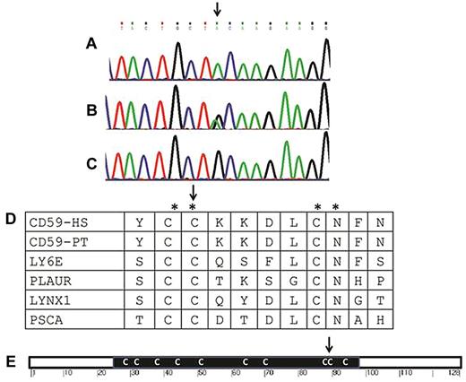 Figure 2. Genomic and protein sequence around the mutation. (A-C) Sequence of exon 3 of CD59 around the Cys89Tyr mutation (arrow) in a patient (A), a carrier (B), and a healthy control (C). (D) Amino acid conservation around the mutation site (CD59-HS, human CD59). The region is not only conserved among the Eutheria (eg, in the CD59 protein of Pan troglodytes, CD59-PT), but also among other LY-6 domain–containing proteins in humans, including the human lymphocyte antigen 6E (LY6E), the human urokinase plasminogen activator surface receptor (PLAUR), the ly-6/neurotoxin-like protein 1 (LYNX1), and the prostate stem cell antigen (PSCA). The conserved residues are marked by an asterisk and the mutated codon by an arrow. (E) Schematic representation of the CD59 protein. The black rectangle stands for the LU domain with its multiple Cys residues (C). The site of the mutation (Cys89) of our patients is shown (arrow).