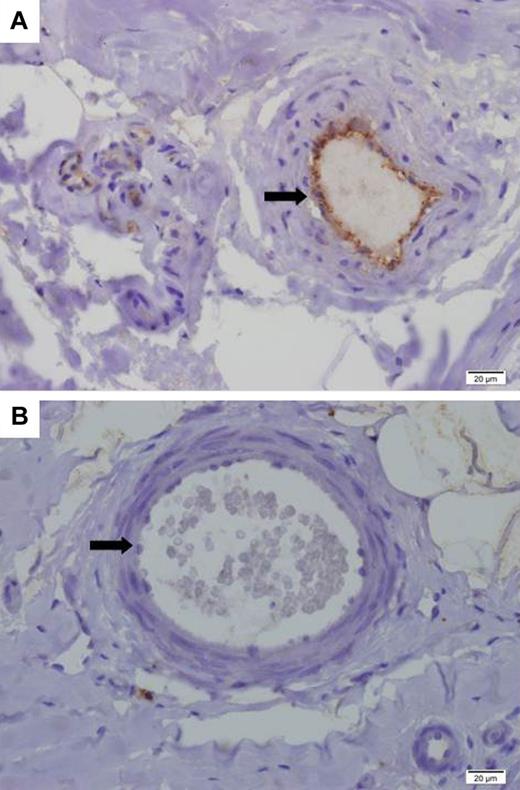 Figure 4. Results of immunohistochemical staining for CD59. Shown are results of immunohistochemical staining (concentration 1:1000) on paraffin sections of a sural nerve biopsy (original magnification, 60×) from a control subject (A) and from patient 2888 (B). There is endothelial (cytoplasmic-luminal pattern) staining of epineurial blood vessels (A; black arrow) in the control subject, whereas is a complete lack of vascular staining in the patient (B; black arrow).