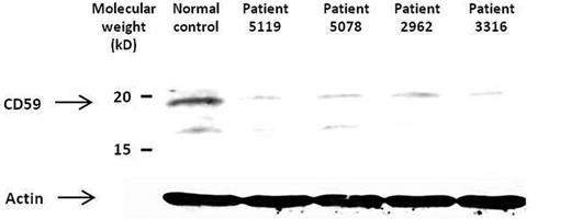 Figure 5. Western blot of the CD59 protein. CD59 was detected by monoclonal mouse anti–human CD59 (Serotec) and anti–mouse IgG horseradish peroxidase (Promega) followed by an enhanced chemiluminescence reaction (Biological Industries) in lymphoblasts. Four patients and a normal control are presented. Actin, as a housekeeping gene, is shown at the bottom.