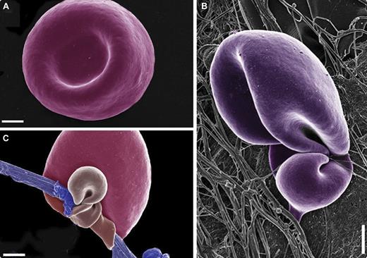 Under physiologic conditions a small percentage (< 3%) of red blood cells (RBCs) are irreversibly trapped within the fibrin clot mesh. By contrast, in prothrombotic states such as diabetes mellitus, significantly more RBCs are tightly bound to fibrin fibers. Such interactions affect clot properties, making it more resistant to fibrinolytic degradation. This phenomenon may explain thrombolytic resistance frequently seen in diabetic patients. In most cases these patients also have higher-than-usual levels of iron. / Using scanning electron microscopy (SEM) to study whole blood smears, RBCs from healthy individuals have the typical sphere-like appearance (panel A). The ferritin and transferrin of these individuals were within the normal ranges at 10 to 120 ng/mL and 2.5 to 3.8 g/L, respectively. However, we found unusual configurations of fibrin fibers interacting with RBCs in diabetes (panel B, where the ferritin and transferrin levels were slightly elevated). In addition, mixing whole blood samples obtained from healthy subjects with ferric chloride (15mM FeCl3 (panel C), as well as a very low concentration of 0.03mM FeCl3—similar to physiologic levels of iron overload) resulted in the formation of similar fibrin-like deposits. Such deposits are closely associated with RBCs, altering the morphology of their cell membranes to trap fibrin fibers (panel C). More than 70% of RBCs have a changed ultrastructure in smears of both diabetic patients and controls with added FeCl3. We conclude that there is a striking similarity between the SEM patterns of whole blood smears from diabetes patients and that of a normal blood samples, mixed with ferric ions. This may explain the pathogenic role of iron overload associated with prothrombotic conditions.