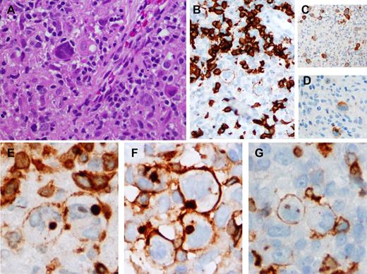 Figure 1. cHL expressing TCAs. (A) Scattered HRS cells amid a background rich in histiocytes and lymphocytes. (B-D) The neoplastic cells express variable weak CD20 (CD20 immunoperoxidase, ×200), uniform CD30 (CD30 immunoperoxidase, ×100), and CD15 (CD15 immunoperoxidase, ×200 respectively. (E-G) CD3, CD4, and CD5 expression, respectively, on the HRS cells. There is membrane staining for CD3 (CD3 immunoperoxidase, ×400), CD4 (CD4 immunoperoxidase, ×400), and CD5, focally (CD5 immunoperoxidase, ×400); additionally, CD3 and CD4 show blob-like cytoplasmic staining.