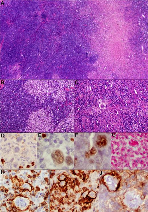 Figure 2. Composite lymphoma comprising cHL and follicular lymphoma. TCA in cHL component. (A) Low-power view of the composite histologic components (H&E, ×100). (B,C) Higher-power view depicting morphologically distinct components; ie, follicular lymphoma grade 3 and cHL, respectively (H&E, ×200). (D-J) Various markers expressed within the HRS cell component with very weak and variable CD20 (D), PAX-5 (E), and BCL-6 (F) expression (immunoperoxidase, ×200, ×400, ×400). (G) These cells are EBER negative (in situ hybridization, ×400). (H-J) TCA expression in cHL component. Among the T-cell markers, there is strong CD3 (H), CD2 (I), and CD4 (J) expression on membrane of the HRS cells (immunoperoxidase, ×400, ×400, ×400). Notably, CD4 was variable in this case with adjoining scattered CD4-negative HRS cells, lending credence to the specificity of staining.