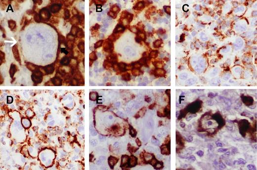 Figure 4. Evaluation of staining for T-cell markers and TCA expression. (A) Indeterminate/negative staining showing lack of definitive membrane accentuation on the HRS cells in areas rosetted by T cells. Free area of HRS cell membrane (denoted with white arrow) opposite to areas of partial rosetting lacks distinctive membrane staining (CD4 immunoperoxidase, ×400). (B) Indeterminate staining showing complete rosetting by CD4-positive T cells without apparent accentuation on the HRS cells (CD4 immunoperoxidase, ×400). (C) Positive staining showing clusters of HRS cells with definitive but incomplete membrane staining. Typically, CD2 and CD7 stains showed areas with frequent incomplete staining patterns (CD2 immunoperoxidase, ×200). Cases with such staining patterns often showed more complete staining pattern in other areas of the same cases or displayed convincing positivity for another T-cell marker. (D) Definitive, complete circumferential membrane staining in clusters of HRS cells (CD2 immunoperoxidase, ×200). (E) Membrane and cytoplasmic Golgi staining for CD8 (immunoperoxidase, ×400). (F) Strong and diffuse cytoplasmic staining for perforin. This case was unique in that almost all HRS cells showed uniform, strong expression of perforin (perforin immunoperoxidase, ×400).