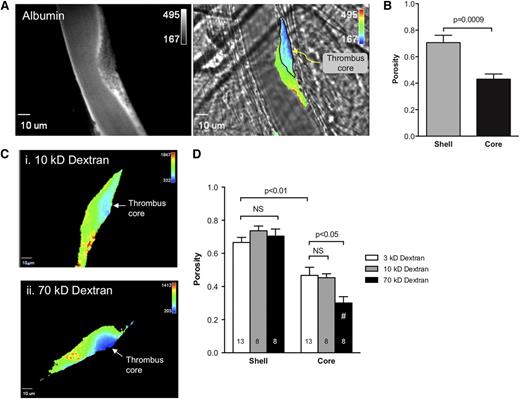 Figure 4. Access of plasma tracers to the core region is size dependent. (A) Representative photomicrographs showing Alexa-488–labeled albumin infused 25 minutes post-injury. The image at the left shows albumin fluorescence. The brightfield image on the right is overlaid with a pseudocolor image depicting albumin intensity within the hemostatic plug. The black line in the pseudocolor image outlines the P-selectin–positive area. A time-lapse video illustrating albumin penetration into this hemostatic plug is included in supplemental Video 3. (B) The graph shows the porosity measured using fluorescent albumin as a tracer for the shell and core regions. Values are mean ± SEM for n = 8 injuries from 4 mice; statistics were performed using a 2-tailed Student t test. (C) Photomicrographs showing representative hemostatic plugs 20 minutes post-injury following infusion of either 10-kDa dextran (Ci) or 70-kDa dextran (Cii). Images are pseudocolored to depict dextran concentration within the platelet mass (the pseudocolored region depicts the entire platelet mass as defined by CD41 fluorescence; blue corresponds to low dextran, red to high dextran). Note the lack of 70-kDa dextran penetration into the core (dark blue region in Cii). (D) The graph shows platelet mass porosity 20 minutes post-injury calculated using 3 different sized dextrans (3 kDa, open bars; 10 kDa, gray bars; and 70 kDa, black bars). Data are expressed as the mean ± SEM porosity within the core and outer shell regions. N = 13 injuries from 4 mice for the 3-kDa dextran, 8 injuries from 4 mice for the 10-kDa dextran, and 8 injuries from 4 mice for the 70-kDa dextran. Statistical comparisons made using a 2-way ANOVA with Bonferroni post-hoc test. NS indicates not significant. #, indicates apparent porosity because the true porosity should be probe-insensitive and the reduced value obtained with 70-kDa dextran represents inadequate access to the core region due to a transport barrier.