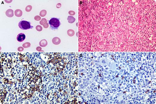 A 26-year-old Indian male presented with a history of dyspnea, fatigue, and jaundice of a month’s duration. He had icterus, pallor, hepatosplenomegaly, severe anemia, thrombocytopenia, and leucocytosis (37 × 109/L) with lymphocytosis. A majority (51%) of the lymphoid cells were large and had folded nuclei, indistinct nucleoli, finely granular basophilic cytoplasm, and circumferentially placed hairy projections (panel A). These cells were also seen in the marrow aspirate. They were positive for CD3, CD7, CD2, and T-cell receptor γδ, and negative for the B-cell markers. The cells were intrasinusoidal in location in the trephine biopsies (panel B). Immunohistochemistry was positive for CD3 (panel C) and negative for CD20 (panel D). The characteristic immunophenotype and intrasinusoidal pattern was consistent with the diagnosis of hepatosplenic T-cell non-Hodgkin lymphoma. Cytogenetics and cytotoxic markers could not be obtained. / T-cell large granular lymphocyte leukemias are usually CD8 positive and CD7 negative, lack the characteristic intrasinusoidal pattern of infiltration, and have an indolent course. Leucocytosis, although uncommon, has been reported previously in this lymphoma. Morphological variations, including blastlike lymphoid cells in the terminal phase, have been described; however, hairy projections, as seen here, are a rarity in this neoplasm.