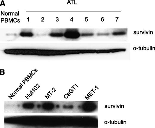 Figure 1. Increased survivin expression in ATL patients’ PBMCs, MET-1 ATL tumor cells, and HTLV-1–infected cell lines. (A) Western blot analysis of survivin protein levels in PBMCs of ATL patients. (B) Western blot analysis of survivin protein levels in MET-1 ATL tumor cells and in HTLV-1–infected cell lines MT-2, Hut102, and CaGT1.