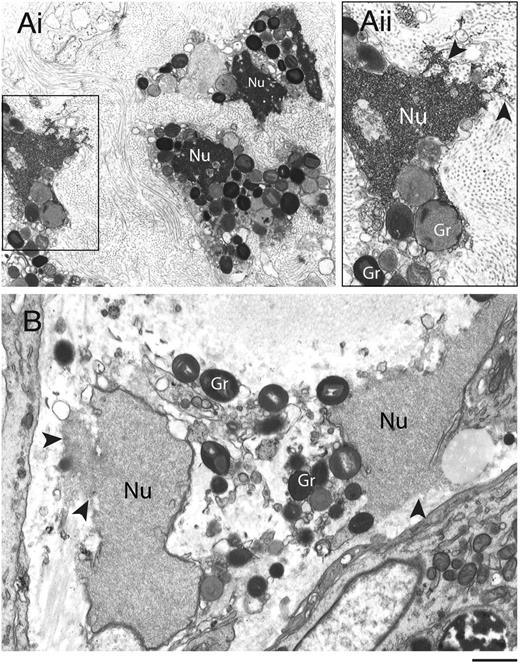 Figure 1. Transmission electron micrographs of human tissue eosinophils from (A) allergic and (B) hypereosinophilic patients. Biopsy samples from the left frontal sinus and the skin were obtained from a patient with allergic sinusitis and a patient with hypereosinophilic syndrome (negative for FIP1-like 1/platelet-derived growth factor-α mutation), respectively. In (Ai), a biopsy of the frontal sinus shows infiltrated eosinophils. Note the disrupting nuclei (Nu) and extracellular free secretory granules. (Aii) is the boxed area of (Ai) seen at higher magnification. In (B), both free granules (Gr) and disrupted nuclei (Nu) are also observed in eosinophils from a skin biopsy. Arrowheads in (Aii) and (B) indicate releasing decondensed chromatin. Samples were fixed in a mixture of glutaraldehyde and PFO and prepared for conventional TEM as in “Materials and methods.” Scale bars represent 1.2µm (Ai), 700 nm (Aii), 600 nm (B).