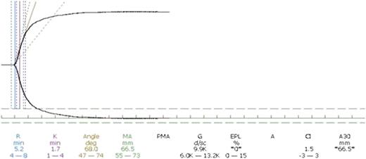 Figure 3. Normal thromboelastography curve. The normal thromboelastographic curve is shown along with the resultant parameters along the bottom of the figure. R represents the time to clot initiation and is measured at the point that the 2 lines have separated 2 mm. K represents the clot propagation and is measured as the time from R until the curves are 20 mm apart. The angle represents the tangential angle of the curve with the horizontal and also represents clot propagation. MA is the maximal amplitude represented as the distance in millimeters between the 2 curves once they are parallel and represents peak clot rigidity.