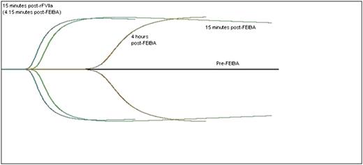 Figure 4. Thromboelastograph curve before and after treatment. The black horizontal line is the patient’s baseline, which is flat and demonstrates no clot formation. The green curve represents 15 minutes after a dose of the bypassing agent, FEIBA 75 IU/kg. The brown curve represents 4 hours after the FEIBA has been infused, demonstrating a degrading of the blood’s clot-forming ability. The blue curve represents 15 minutes after a dose of rFVIIa, 90 μg/kg, demonstrating the additive effect of the 2 agents.