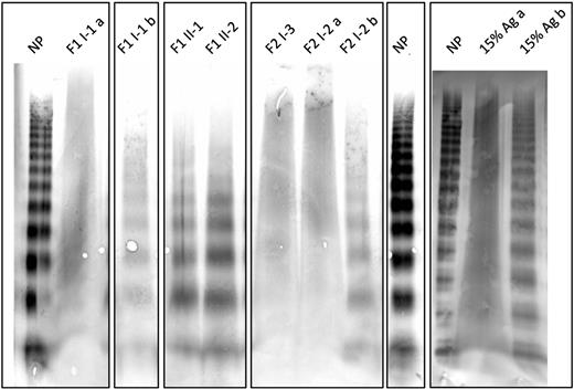 Figure 1. Multimer analysis of patients heterozygous for the p.L1696R or p.P1824H mutation. VWF multimeric pattern from plasma samples of patients and affected family members. A sample from F2 I-1 was not available for analysis. For 2 individuals (F1 I-1 and F2 I-2), samples were analyzed twice using a 1:1 (indicated as 15% Ag a) or 1:2 dilution (indicated as 15% Ag b). Samples of patients F1 II-1 and F1 II-2 were diluted 1:2, whereas plasma of patient F2 I-3 was diluted 1:1. To demonstrate the role of sample dilution on multimer quality, VWF-deficient plasma was mixed with normal pooled plasma to a final concentration of 15% VWF:Ag. This preparation was subject to multimer analysis using a 1:1 (15% Ag a) or a 1:2 (15% Ag b) dilution. NP, normal pooled plasma.