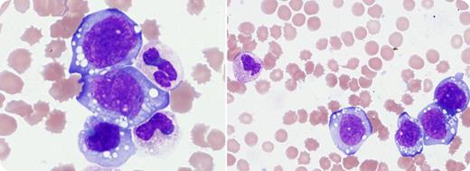 A 25-year-old woman presented with lymphadenopathy. Peripheral blood showed leukocytosis, anemia, and thrombocytopenia (white blood cell count, 102.9 × 109/L; hemoglobin level, 76 g/L; and platelet count, 32 × 109/L). Peripheral smear demonstrated a predominant population of large cells with reticular chromatin, folded to irregular nuclear contours, and abundant basophilic cytoplasm. Many cells contained cytoplasmic vacuoles. By flow cytometry, these cells were within the monocyte gate (CD45/side scatter) and expressed the myeloid-associated marker CD13, in addition to CD56, HLA-DR, CD5, CD7 (partial), and cytoplasmic CD3 (dim). They were negative for CD33, CD34, CD117, CD19, CD3, CD4, and CD8. Cytochemically, the cells were negative for butyrate and chloroacetate esterases. A lymph node biopsy showed ALK-positive anaplastic large cell lymphoma (ALCL). Peripheral blood fluorescence in situ hybridization demonstrated ALK gene rearrangement in 97.5% of nuclei, confirming a leukemic phase of the ALK-positive ALCL. / ALCL is a peripheral T-cell lymphoma characterized by large pleomorphic lymphoid cells with abundant cytoplasm. Leukemic phase of ALCL is rare but associated with poor prognosis. It is most commonly seen in ALK-positive ALCLs and frequently presents as small circulating lymphoid cells. In this case, the peripheral blood cells were large and demonstrated morphologic and flow-cytometric features requiring differentiation from an acute monocytic leukemia.