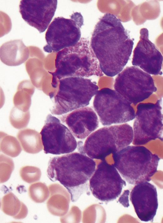 Acute promyelocytic leukemia. Image courtesy of Michael W. Beaty, Department of Pathology, Wake Forest School of Medicine.