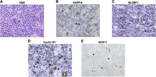 Figure 7. Plasma cells in MCL tumors are SOX11 negative. (A) MCL with focal plasmacytic differentiation. Some cells show Dutcher bodies corresponding to the accumulation of restricted immunoglobulins (arrow) (H&E; ×60). (B-C) Tumor cells expressing restricted kappa light chain and BLIMP1 (×60). (D) Tumor cells expressing cyclin D1 (×60). (E) SOX11 expression is negative in the tumor cells but positive in internal controls such as endothelial and histiocytic cells (×60). Arrows point to tumor cells with Dutcher bodies.