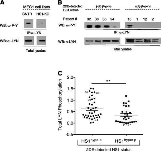 Figure 1. HS1 status is associated with differential LYN phosphorylation in CLL cells. (A) Total LYN tyrosine phosphorylation (upper panels) was evaluated after IP with an anti(α)-LYN antibody and WB for total phosphotyrosines on CNTR and HS1-KD MEC1 cell lines, showing LYN phosphorylation only in CNTR cells. Total LYN protein levels (lower panels) are detected by WB, as a control. (B) Total LYN tyrosine phosphorylation (upper panels) was detected as in (A) on primary CLL samples (patient numbers are the same as in supplemental Tables 1 and 2) with different 2DE-detected HS1 phosphorylation status (HS1hypo-p, HS1hyper-p), showing higher LYN phosphorylation in HS1hypo-p samples. Total LYN protein levels (lower panels) were detected by WB, as a control. (C) In the dot plot, densitometric analysis of total LYN tyrosine phosphorylation, detected as in (A), are shown from the entire cohort of 63 primary samples, divided into 2 groups based on 2DE-detected HS1 phosphorylation status (n = 36 HS1hypo-p vs n = 27 HS1hyper-p). The numbers refer to the representative samples displayed in (B). Means ± SEM of the OD ratio between total LYN tyrosine phosphorylation and total LYN protein levels are shown. Significantly higher total LYN phosphorylation was observed in HS1hypo-p samples, as compared with HS1hyper-p. **P ≤ .01, Mann-Whitney U test. P-Y, phosphotyrosines.