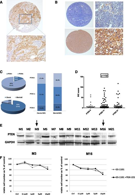Figure 2. Loss of PTEN expression in MCL. (A) Core from a PTEN-null adenocarcinoma control showing PTEN-negative tumor islands surrounded by PTEN-positive stroma by IHC (original magnifications ×50 and ×200). (B) Representative images of MCL cores with and without loss of PTEN expression (original magnifications ×50 and ×200). Macrophages and blood vessels were used as internal controls. (C) Pie chart showing the proportion of all biopsies with PTEN loss and blastoid morphology accompanied by a bar graph of distribution of PTEN loss in blastoid and nonblastoid MCL. (D) Dot plot comparing p110β expression levels between cores with and without loss of PTEN expression showing no difference among the 3 groups (PTEN−, PTEN 1+, and PTEN2+). There was also no significant difference in expression of p110α and δ between these groups (data not shown). (E) Western blot for PTEN expression in 12 MCL cell suspensions showing loss of expression in 2 samples (indicated by arrows). (F) Results of ATP cytotoxicity assay after 72 hours’ treatment showing no benefit from addition of a p110β-selective inhibitor to GS-1101 in 2 MCL suspensions exhibiting loss of PTEN expression.