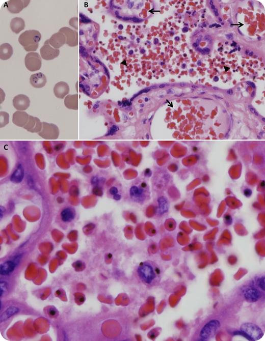 A 26-year-old, gravida 1, para 0, 37-week-pregnant immigrant from Burkina Faso presented with a 1-week history of intermittent fevers, headache, and myalgia. She had a past medical history of malaria (10 years before admission) in Burkina Faso, where she most recently visited on a 2-week trip about 2 months prior to admission. A complete blood count showed anemia and thrombocytopenia (hemoglobin 7.4 g/dL, reticulocytes 7.4%, platelets 70 × 109/L). A peripheral smear demonstrated intraerythrocytic ring forms of Plasmodium falciparum (panel A) and an estimated parasitemia rate of 3.6%. Treatment with intravenous quinine and clindamycin was initiated and the patient underwent emergent cesarean delivery (1.5 hours after the first dose of quinine) for nonreassuring fetal tracing. Histologic sections of the placenta showed acute low-grade intervillousitis with numerous maternal red blood cells containing malaria pigment (panel B arrowheads and panel C) and unremarkable fetal vascular circulation (panel B arrows). The final diagnosis was acute malaria in the mother with parasite sequestration in the villous chamber. The patient completed a 7-day course of quinine and clindamycin. Both she and her son had an uneventful recovery. When readily available (unlike in our case), intravenous artesunate is the preferred treatment of severe malaria.