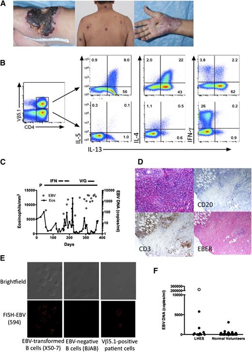 Figure 1. Clinical and laboratory manifestations of EBV-driven LHES. (A) Skin lesions before (left and center panels) and during (right panel) prednisone therapy. (B) Intracellular production of IL-4, IL-5, IL-13, and IFN-γ by viable CD3+CD4+ Vβ5.1-positive (top panels) and -negative (bottom panels) T cells. (C) Absolute eosinophil count and EBV DNA in the blood as a function of time. P, prednisone; IFN, interferon-α; V/G, vorinostat/ganciclovir. (D) Paraffin-embedded sections of a skin biopsy stained with hematoxylin and eosin (top left panel) showing dense eosinophilic infiltrate in the upper dermis, antibody to CD3 (bottom left panel), antibody to CD20 (top right panel) and in situ hybridization for EBER (bottom right panel). Magnification, ×400. (E) EBV DNA localization by fluorescence in situ hybridization showing EBV DNA in the nucleus of EBV-positive transformed B cells and in the patient’s Vβ5.1-positive T cells, but not in EBV-negative B cells. (F) Quantitative EBV DNA PCR in peripheral blood from normal volunteers and patients with LHES. Symbols represent individual subject data. ○, The value for the subject with EBV-driven LHES.