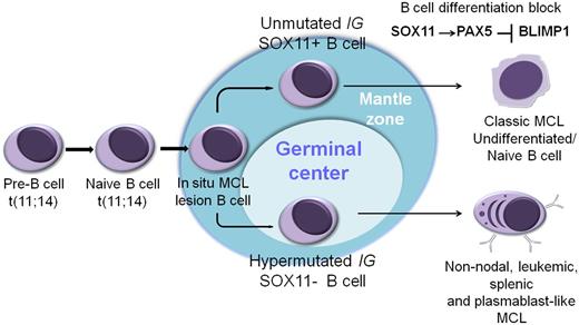 Hypothetical models of SOX11-possitive vs SOX11-negative MCL. The naive B cell carrying the t(11;14) colonizes the mantle zone of the lymphoid follicle and generates an in situ MCL lesion. Most MCLs evolve from these cells in the marginal zone with no or limited IGHV somatic mutations and SOX11 expression. SOX11 overexpression in conventional MCL may block the cells in a mature B-cell stage, preventing their further differentiation thought the SOX11-PAX5-PRDM1/BLIMP regulatory axis. Alternatively, some cells with the t(11;14) may enter the germinal center, undergo IGHV somatic hypermutation, and lack expression of SOX11. SOX11 may modulate the mature B-cell and early plasma cell differentiation program in MCL.