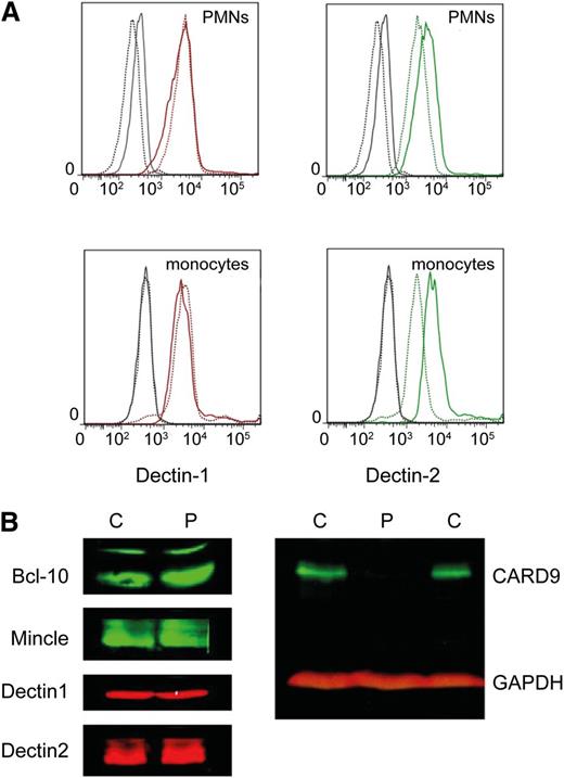 Figure 1. CARD9 deficiency in a patient with systemic candidemia. (A) Surface expression of (left) Dectin-1 and (right) Dectin-2 in control and patient PMNs and monocytes was measured by flow cytometry. Dotted lines represent controls and solid lines patient cells. Isotype controls are shown in gray. Comparable amounts of dectins were detected on the surface of patient and control cells. (B) Western blot detection of C-type lectins (Dectin-1, Dectin-2, and Mincle) as well as Bcl-10 and CARD9 in control and patient neutrophils (indicated as C and P, respectively). GAPDH was used as a loading control. Results are representative for 3 independent experiments. GAPDH, glyceraldehyde-3-phosphate dehydrogenase.