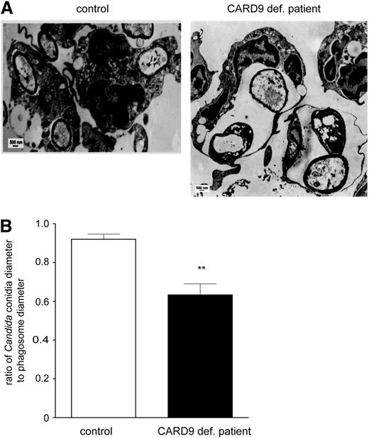 Figure 5. Phagolysosome formation upon uptake of C albicans by human neutrophils. (A) CARD9-deficient and control neutrophils were cocultured overnight with unopsonized C albicans. Ultrastructural analysis was performed by EM. EM pictures showed bulging phagolysosome formation upon uptake of C albicans in the patient neutrophils in contrast to the control neutrophils, obtained in 3 independent experiments. (B) The ratio of Candida conidia diameter to the phagosomal space diameter is significantly reduced in CARD9-deficient neutrophils, taking into consideration that the diameter of the Candida conidia was significantly increased in the case of CARD9 deficiency compared with the control (1.3 ± 0.2 μm vs 0.8 ± 0.1 μm; P < .05). Moreover, the phagosomes of CARD9-deficient neutrophils contained more Candida conidia than the control neutrophils (1.5 ± 0.1 vs 1.1 ± 0.1 conidia/phagosome, P < .05). Taken together, the phagosomes of the CARD9-deficient patient have a strongly enlarged appearance. Results are means ± SEM of measurement from 3 independent experiments; **P < .001.