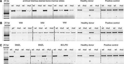 Figure 2. AS-PCR assay. PCR products were separated on 3% agarose gel electrophoresis, and for each sample, the wild-type (WT) and the mutant (MUT) allele were amplified. (A) Archival Giemsa-stained BM slides samples. (B) WM mutated cases presenting both the wild-type and the mutant allele. (C) Mutated and wild-type cases of SMZL and B-CLPD. A WM sample with MYD88 (L265P) mutation was used as a positive control, and a healthy donor was used as a negative control.