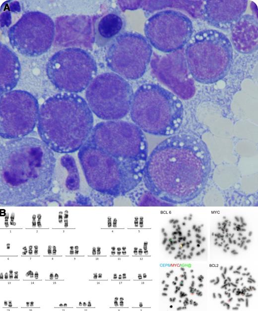 A 68-year-old patient was admitted to our hospital with a short history of constipation and dyspnea. Cytology of the pleural effusion revealed large blastoid B cells. Positron emission tomography/computed tomography scan showed extensive fluorodeoxyglucose activity. In the bone marrow aspirate, large blasts with deeply basophilic cytoplasm and numerous vacuoles resembling Burkitt cells (panel A) were present. Cytogenetic and fluorescence in situ hybridization analysis showed MYC, BCL2 (double hit), and BCL6 (triple hit) rearrangements within a complex karyotype (panel B), seen in about 5% to 15% of diffuse large B-cell lymphomas (DLBCL). It was therefore classified according to the World Health Organization as a B-cell lymphoma unclassifiable with features intermediate between DLBCL and Burkitt lymphoma due to the distinct cytogenetic alterations. Because of the aggressive behavior of the disease, we treated with 3 cycles of rituximab hyper-CVAD/rituximab high-dose methotrexate and 6 intrathecal chemoprophylaxes. Positron emission tomography/computed tomography scan showed complete resolution and the patient was well. However, disease recurrence was documented shortly after. The patient died despite reinduction with rituximab-DHAP. / Double- and triple-hit lymphomas are chemosensitive aggressive B-cell lymphomas, but unlike Burkitt lymphoma and DLBCL they have a very high recurrence rate and are almost always fatal. Proper molecular characterization of lymphomas to determine prognosis is very important for patient advice and treatment decision.