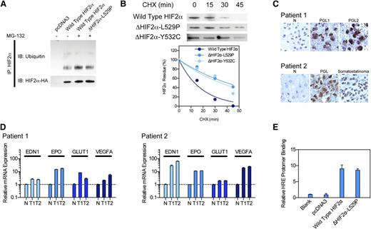 Figure 2. HIF2A mutation lead to pseudohypoxic change and tumor formation. (A) Immunoprecipitation assay measuring HIF-2α ubiquitination, showing decreased protein ubiquitination in mutant protein. (B) CHX assay measuring HIF-2α stability, showing elongated protein half-life. (C) Immunohistochemistry staining of HIF-2α in tumor specimens, showing increased HIF-2α protein in tumors. (D) Quantitative polymerase chain reaction assay showing increased hypoxia-related gene expression in tumor specimen. (E) Chromatin immunoprecipitation assay showing intact DNA-binding efficiency of mutant HIF-2α.