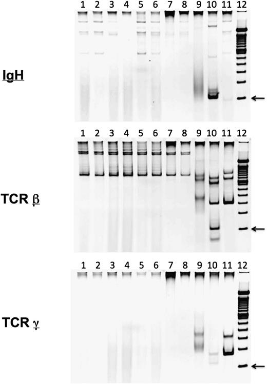 Figure 5. Analyses of TCR and IgH gene rearrangements in iPSC lines. iPSC lines were tested for TCRβ, TCRγ, and IgH recombination by genomic DNA PCR using InvivoScribe Clonality Assays. Eight independent iPSC lines from 7 different donors (lanes 1-8) are shown: iNC-01 (lane 1), iGP91-03-1 (lane 2), iGP91-03-2 (lane 3), iGP91-04 (lane 4), iGP91-05 (lane 5), iGP91-06 (lane 6), iSCID-02 (lane 7), and iSCID-03 (lane 8). InvivoScribe Clonality Assay controls are shown as polyclonal (lane 9) and 2 different clonal controls (lanes 10 and 11) for each set. A 100-bp DNA ladder is also shown (lane 12). PCR products within the valid range of 69 to 129 bp for IgH, 80 to 220 bp for TCRγ, and 170 to 325 bp for TCRβ are shown. The arrow indicates the 100-bp size marker. The data shown are representative of 22 iPSC lines from 17 different donors.