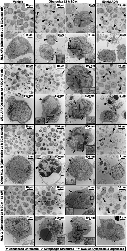 Figure 7. Electron microscopy evidence of apoptosis, autophagy, and necroptosis in obatoclax-treated primary infant ALL cells. Cases are the same as in Figure 6A-D. Molecular cytogenetic subtype and 72-hour obatoclax EC50s from surviving fraction plots in Figure 1 are at left. Cells were treated for 48 hours with vehicle, obatoclax at respective 72-hour obatoclax EC75 or 50 nM ADR, and harvested, stained, and sectioned for electron microscopy. Different arrowheads mark condensed chromatin of apoptosis, autophagic structures, or swollen organelles of necroptosis. Magnified insets are in boxes. Note morphologic findings indicating all 3 modes of death, including examples in single cells in all cases. Also note chromatin condensation as well as less prominent autophagic structures in ADR control cells in all cases.
