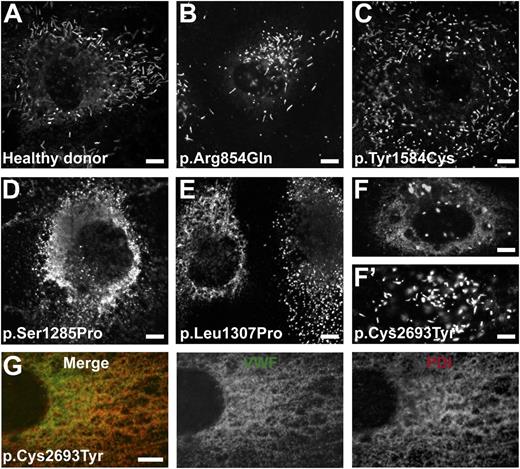 Figure 2. Storage of VWF in BOECs. BOECs derived from a healthy donor or patients with mutations as indicated were grown on collagen type 1–precoated coverslips until confluent. (A-F′) Cells were fixed and stained for VWF. The punctate staining indicates storage of VWF in WPB, whereas the diffuse staining in (D-F) indicates VWF retained within the ER. (G) Representative image showing that the diffuse VWF staining observed in BOECs derived from the patient heterozygous for p.Cys2693Tyr was colocalized with the PDI. BOECs were fixed and stained for VWF (middle, green) and the ER marker PDI (right, red). Merge of VWF and PDI staining is also shown (left). Note that the majority of WPB observed in BOECs derived from the patients heterozygous for VWF p.Ser1285Pro, p.Leu1307Pro, and p.Cys2693Tyr were short or round instead of elongated, as seen in (A). (F′) Cell derived from the patient heterozygous for p.Cys2693Tyr with WPB of normal morphology. (Scale bars, 5 μm.) All images were taken by Leica SL confocal laser scanning microscopy with a 63×/1.40 NA oil objective.
