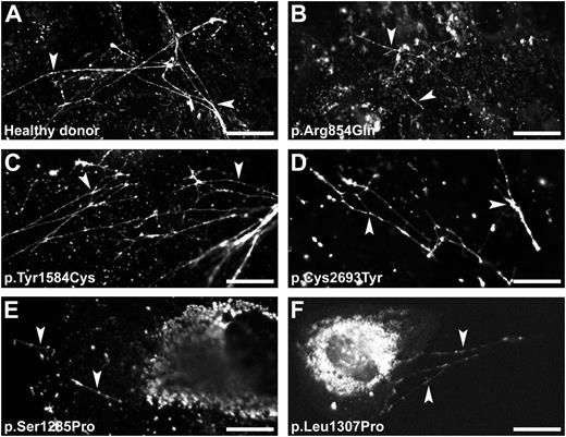 Figure 6. VWF string formation on exocytosis of WPB. BOECs derived from a healthy donor (A) or from the patients heterozygous for a VWF mutation (B-F) were stimulated for 60 minutes with 100 μM histamine at 37°C. Cells were fixed and stained for VWF to visualize the VWF string-like structures (arrowheads). (Scale bars, 20 μm.) All images were taken by Leica SL confocal laser scanning microscopy with a 63×/1.40 NA oil objective.