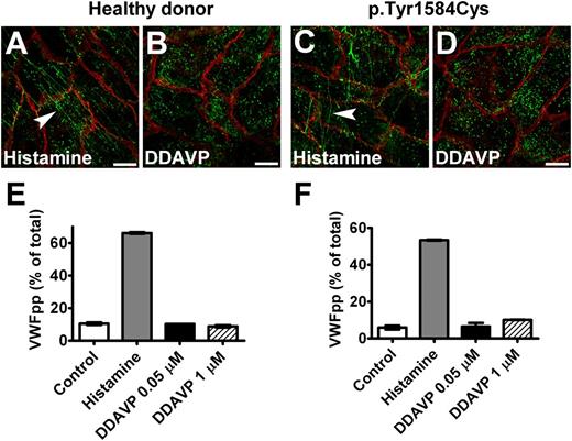 Figure 7. Response of BOECs to DDAVP. BOECs derived from a healthy donor (A,B) or the patient heterozygous for p.Tyr1584Cys (C,D) showed VWF strings (indicated by arrowheads) after incubation with 100 μM histamine for 1 hour (A,C), but no strings were seen after stimulation with 1 μM DDAVP (DDAVP) for 2 hours (B,D). Cells were fixed and stained for VWF (green) and β-catenin (red). (Scale bars, 20 μm.) All images were taken by Leica SL confocal laser scanning microscopy with a 63×/1.40 NA oil objective. (E,F) Cells derived from a healthy donor (donor 1) (E) and from the patient heterozygous for p.Tyr1584Cys (F) were cultured in 12-well plates at passage 6. Confluent cell layers were incubated for 60 minutes at 37°C in the absence (Control) or presence (Histamine) of 100 μM histamine or DDAVP (DDAVP) at indicated final concentrations. There was no response to DDAVP. Mean ± SEM indicates variation between triplicate measurements.