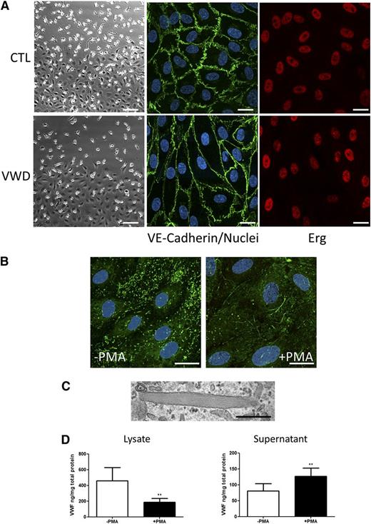 Figure 1. BOEC characterization and activation with PMA. (A) Representative images at the edge of a confluent colony of BOECs from a healthy control (top far left) and VWD patient (bottom far left). Scale bars represent 100 µm. Colonies of confluent BOECs were stained for VE-cadherin and Erg. Nuclei were stained with TO-PRO3 (scale bars represent 20 µm). (B) Representative image of healthy control BOECs stimulated with PMA or control to induce WPB exocytosis. BOECs were stained for IF with antibody to VWF and TO-PRO3 to identify the nuclei. Strings of VWF can be seen associated with the cell surface in the PMA-treated samples (scale bars represent 20 µm). (C) Representative EM image of a single WPB from a healthy control BOEC (scale bar represents 500 nm). (D) BOEC VWF was quantified by ELISA in total cellular lysate (left) or in cell culture supernatant (right) in the presence or absence of PMA stimulation (mean ± SEM from 9 healthy controls). **P < .01.