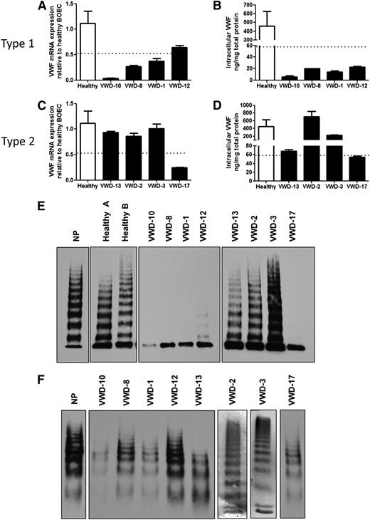 Figure 2. Expression of VWF in plasma and BOECs from type 1 and 2 VWD patients. (A,C) Real-time RT-PCR with primers specific for VWF was performed on RNA isolated from BOECs from 4 healthy controls and from type 1 (A) or type 2 (C) VWD patients. The VWF expression was normalized to glyceraldehyde-3-phosphate dehydrogenase, and all samples were normalized to 1 healthy control. The mean expression of controls was 1.12 (range, 0.52-1.70). (B,D) VWF protein was measured in total cellular lysates from healthy control BOECs (mean, 458 ng/mg total protein; range, 59-1390) and type 1 (B) or 2 (D) VWD BOECs with a VWF ELISA. In (A-D), the dotted line indicates the lowest value in healthy donors for mRNA and protein, as the lower limit of the normal range (mean ± SEM from 4 to 9 healthy controls, see “Materials and methods”). (E,F) VWF multimer analysis of VWF from BOEC lysates (E) or plasma (F).