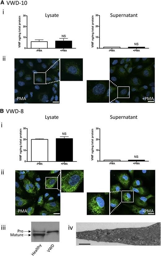 Figure 3. BOEC characterization: type 1 VWD. Data from patient VWD-10 (A) and patient VWD-8 (B). (Ai,Bi) VWF was measured by ELISA in the total cell lysate (left) and cell culture supernatant (right) from BOECs isolated from the indicated patient, in the absence and presence of PMA stimulation (mean ± SEM from 3 replicates). (Aii,Bii) VWF expression from control or PMA-stimulated BOECs was visualized by confocal IF microscopy (scale bars represent 20 µm). Boxes show 2× magnified image. (Biii) Mature and propeptide-containing VWF was detected by western blotting from a healthy control or VWD patient VWD-8. Equal amounts of VWF were loaded per lane. (Biv) Representative image from EM analysis of BOECs from VWD patient VWD-8 shows extensive ER (scale bar represents 200 nm).
