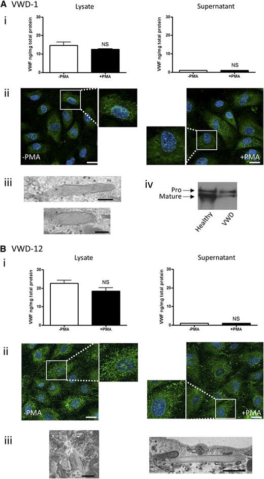 Figure 4. BOEC characterization: type 1 VWD. Data from patient VWD-1 (A) and patient VWD-12 (B). (Ai,Bi) VWF was measured by ELISA in the total cell lysate (left) and cell culture supernatant (right) from BOECs isolated from the indicated patient in the absence and presence of PMA stimulation (mean ± SEM from 3 replicates). (Aii,Bii) VWF expression from control or PMA-stimulated BOECs was visualized by confocal IF microscopy (scale bars represent 20 µm). Boxes show 2× magnified image. EM analysis of BOECs show elongated (Aiii,Biii) or rounded WPBs (Biii) (scale bars represent 200 nm in Aiii and 500 nm in Biii). (Aiv) Mature and propeptide-containing VWF was detected by western blotting from a healthy control and VWD-1. Equal amounts of VWF were loaded per lane.