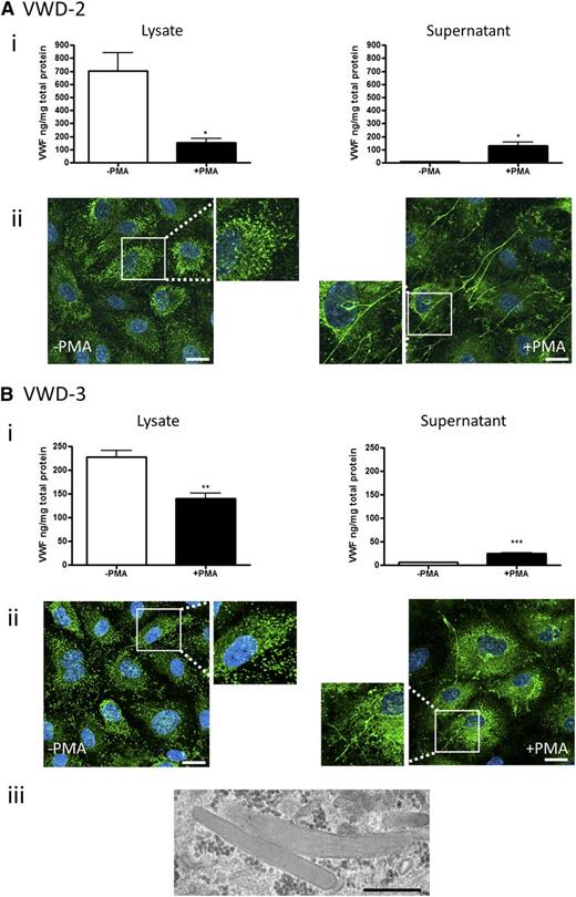 Figure 6. BOEC characterization: type 2M VWD family. Data from patient VWD-2 (A) and patient VWD-3 (B). (Ai,Bi) VWF was measured by ELISA in the total cell lysate (left) and cell culture supernatant (right) from BOECs isolated from the indicated patient in the absence and presence of PMA stimulation (mean ± SEM from 3 replicates). (Aii,Bii) VWF expression in control or PMA-stimulated BOECs was visualized by confocal IF microscopy (scale bars represent 20 µm). Boxes show 2× magnified image. (Biii) Representative image from EM analysis (scale bar represents 500 nm) of BOECs from patient VWD-3 illustrates the presence of morphologically normal WPBs. *P < .05; ** P < .01; ***P < .001.
