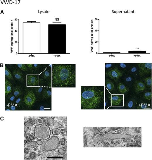 Figure 7. BOEC characterization: type 2M VWD. (A-C) Data from patient VWD-17. (A) VWF was measured by ELISA in the total cell lysate (left) and cell culture supernatant (right) from BOECs in the absence or presence of PMA stimulation (mean ± SEM from 3 replicates). (B) VWF expression from control and PMA-stimulated BOECs was visualized by confocal IF microscopy (scale bars represent 20 µm). Boxes show 2× magnified image. (C) EM analysis of BOECs (scale bars represent 200 nm) shows the presence of rounded WPBs (left), plus a rare elongated WPB (right). ***P < .001.